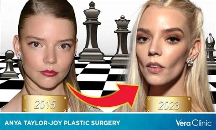 Anya Taylor-Joy’s Plastic Surgery: Did The Menu Cast Have Blepharoplasty, Brow Lift, and Buccal Fat Removal?