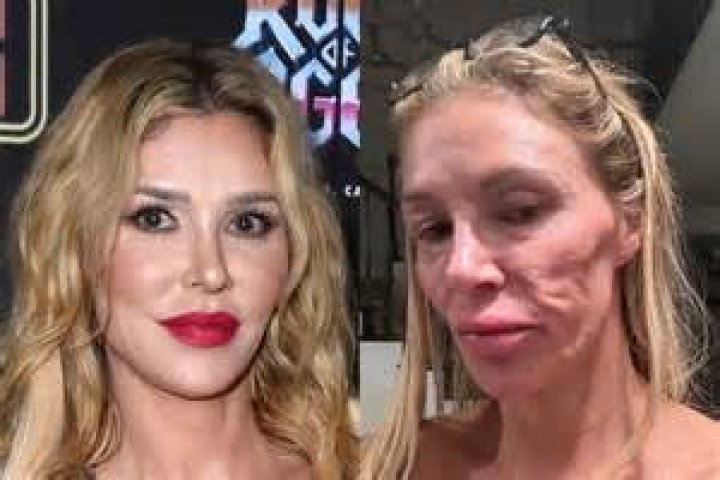 Brandi Glanville Posts Shocking Picture Of Her Burned Face In Response To Plastic Surgery Rumors – Here’s What Actually Happened To Her!