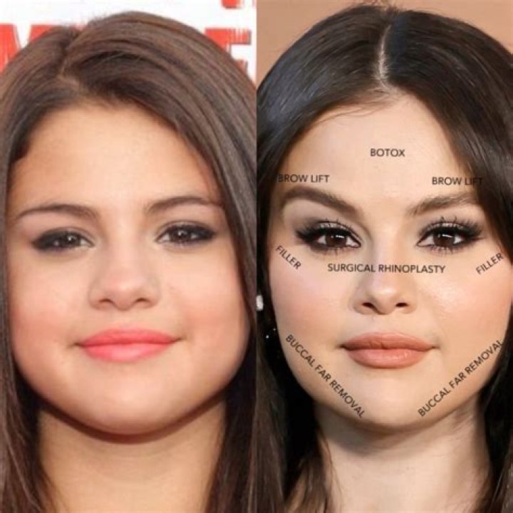 Did She Get Botox? Her Before And After Plastic Surgery Pictures