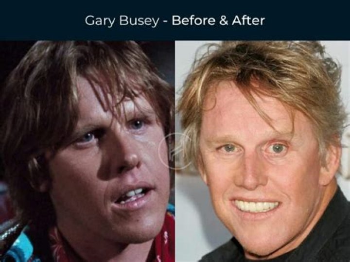 Gary Busey Before and After Motorcycle Accident: Did The Actor Lose His Mind?