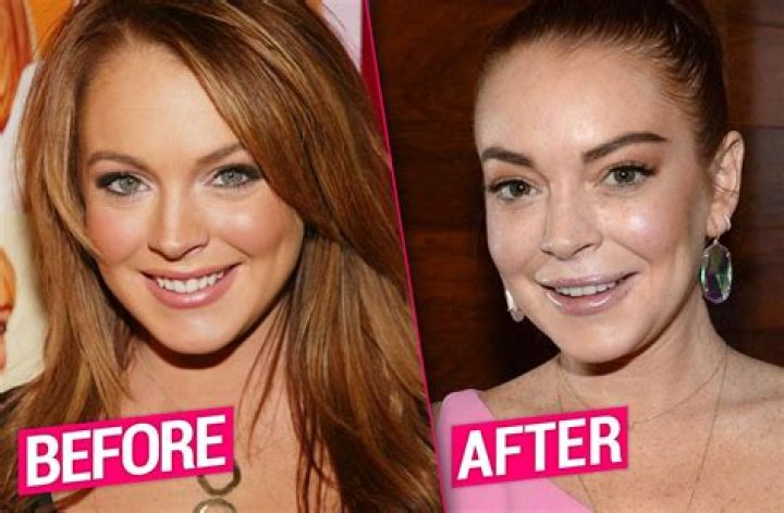 Lindsay Lohan Plastic Surgery: From Rhinoplasty to Fillers and Everything We Know So Far!
