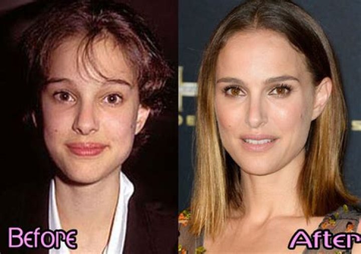 Natalie Portman Plastic Surgery: Portman's Changing Nose Capturing Fans' Attention!