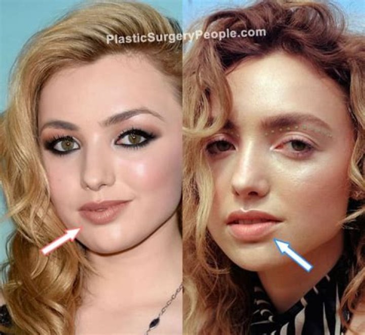 Peyton List Plastic Surgery: Before And After Photos