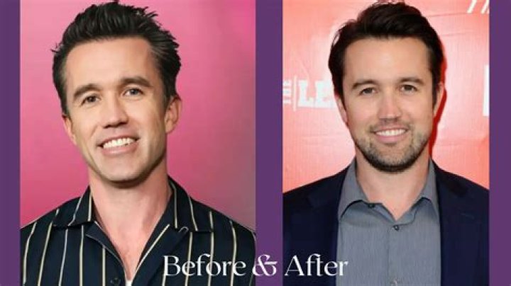 Rob Mcelhenney Plastic Surgery: Opting for Surgical Measures Or The Process of Reshaping Himself?