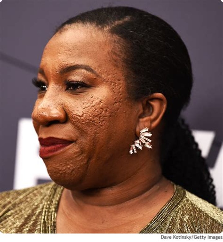 What Happened to Tarana Burke Face? Skin Condition Explained